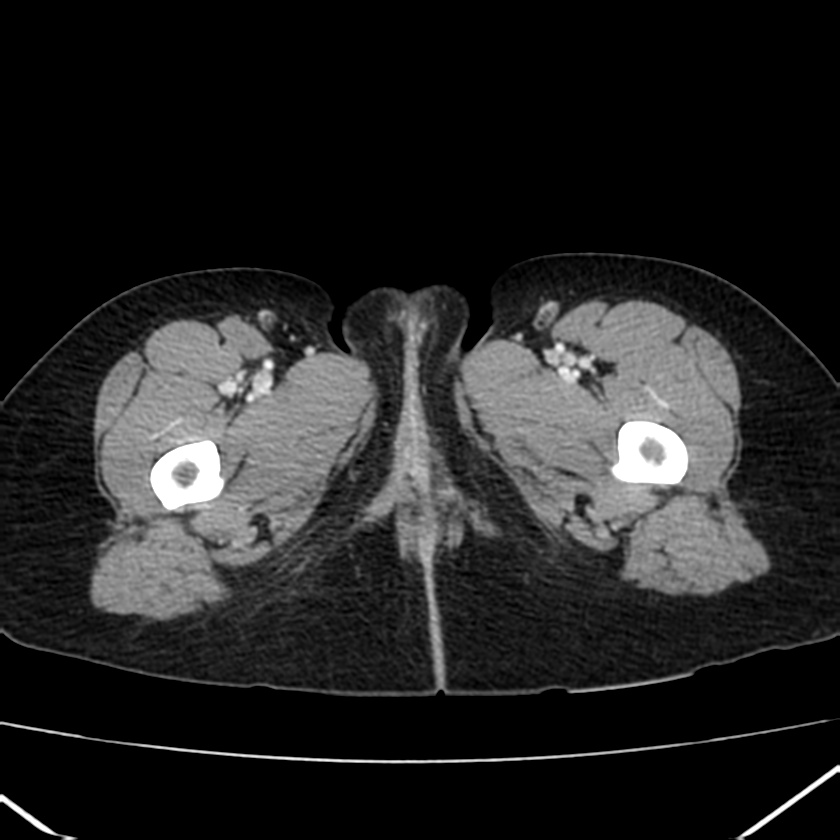 Ampullary tumor (Radiopaedia 22787-22816 C 79).jpg