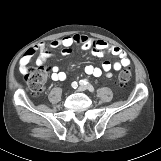 File:Amyand hernia (Radiopaedia 39300-41547 A 47).png