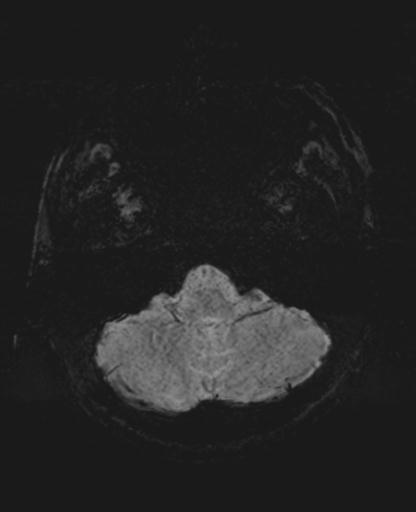 File:Amyloid angiopathy with inflammation (Radiopaedia 30360-31002 Axial SWI MIP 2).jpg