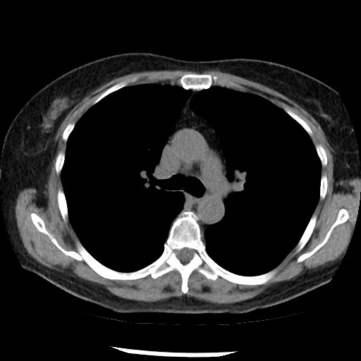 Amyloidosis - bronchial and diffuse nodular pulmonary involvement (Radiopaedia 60156-67744 Axial non-contrast 23).jpg