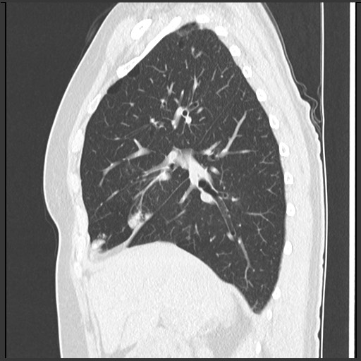 Amyloidosis - bronchial and diffuse nodular pulmonary involvement (Radiopaedia 60156-67744 F 20).jpg