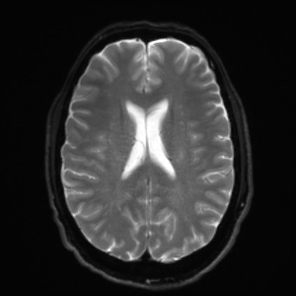 File:Amyotrophic lateral sclerosis (Radiopaedia 87352-103658 Axial DWI 17).jpg
