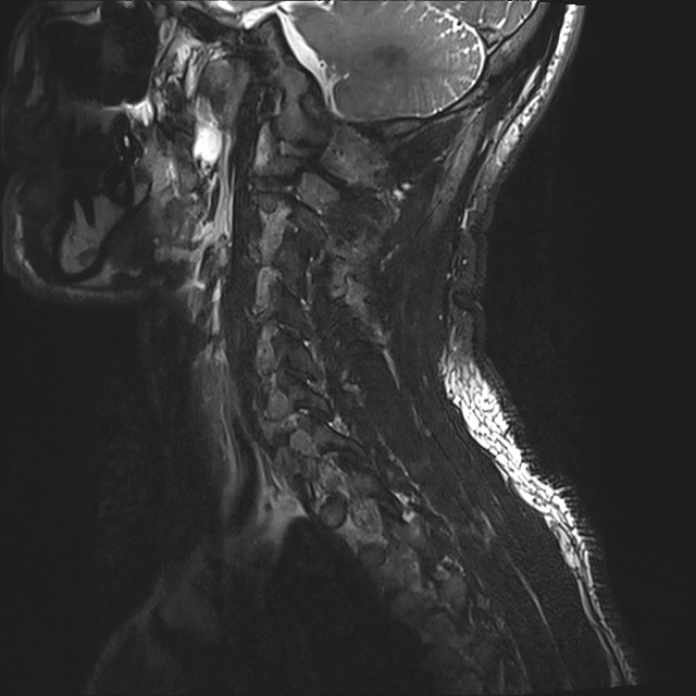 Amyotrophic lateral sclerosis (Radiopaedia 87352-103658 I 6).jpg