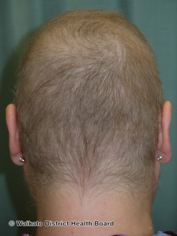 File:Anagen effluvium- regrowth after chemotherapy (DermNet NZ hair-nails-sweat-w-anagen-effluvium-06).jpg