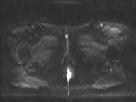File:Anal adenocarcinoma - tumor regression grade 1 (Radiopaedia 31358-32101 Axial DWI 5).jpg