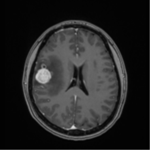 Anaplastic astroblastoma (Radiopaedia 55666-62194 Axial T1 C+ 47).png