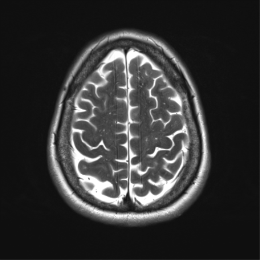 File:Anaplastic astrocytoma - thalamic glioma (Radiopaedia 59709-67115 Axial T2 30).png