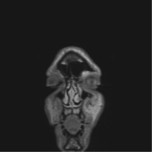 Anaplastic astrocytoma IDH mutant (Radiopaedia 50046-55341 Coronal FLAIR 59).png