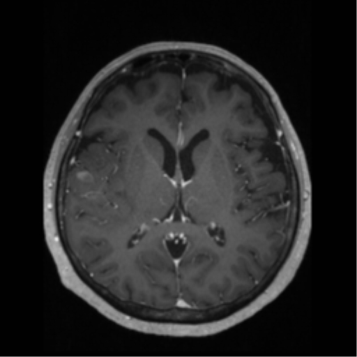 File:Anaplastic astrocytoma IDH wild-type (pseudoprogression) (Radiopaedia 42209-45276 Axial T1 C+ 82).png