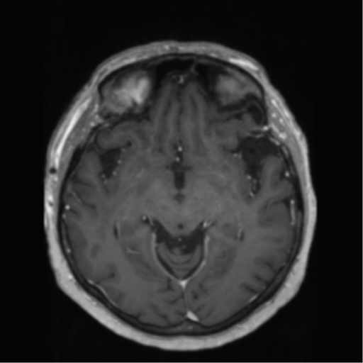 File:Anaplastic astrocytoma IDH wild-type (pseudoprogression) (Radiopaedia 42209-45278 Axial T1 C+ 72).png