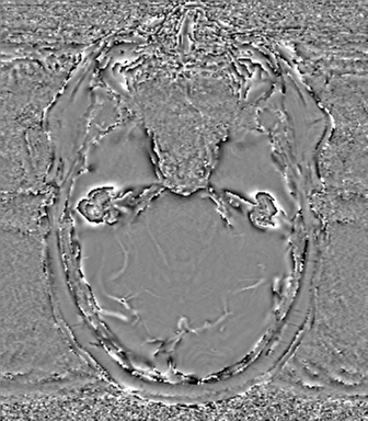 Anaplastic oligodendroglioma (Radiopaedia 83500-98599 Axial SWI - phase 24).png