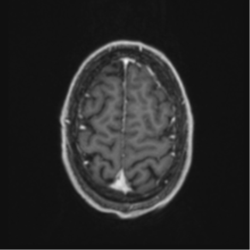 Anaplastic oligodendroglioma with skull fracture (Radiopaedia 74831-85845 Axial T1 C+ fat sat 57).png
