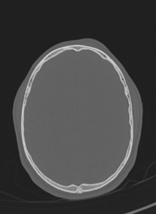 Anaplastic oligodendroglioma with skull fracture (Radiopaedia 74831-85846 Axial bone window 14).png