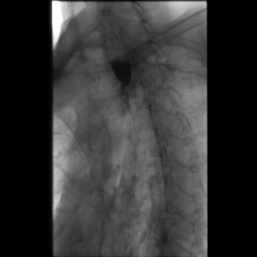 File:Anastomotic stricture post Ivor Lewis esophagectomy (Radiopaedia 47937-52715 Oblique 12).png