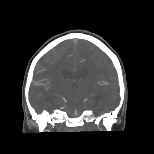 Aneursym related subarachnoid hemorrhage with hydrocephalus (Radiopaedia 45105-49084 B 44).jpg