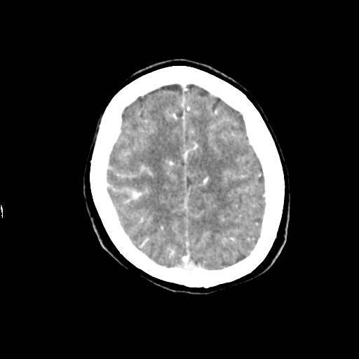 Aneursym related subarachnoid hemorrhage with hydrocephalus (Radiopaedia 45105-49084 D 43).jpg
