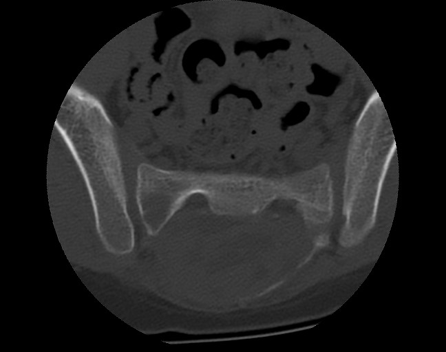Aneurysmal bone cyst - sacrum (Radiopaedia 65190-74195 Axial bone window 27).jpg