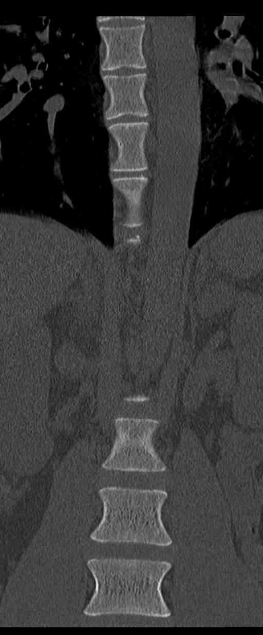 Aneurysmal bone cyst T11 (Radiopaedia 29294-29721 Coronal bone window 15).jpg