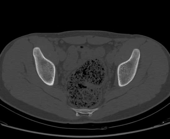 File:Aneurysmal bone cyst of ischium (Radiopaedia 25957-26094 Axial bone window 45).png