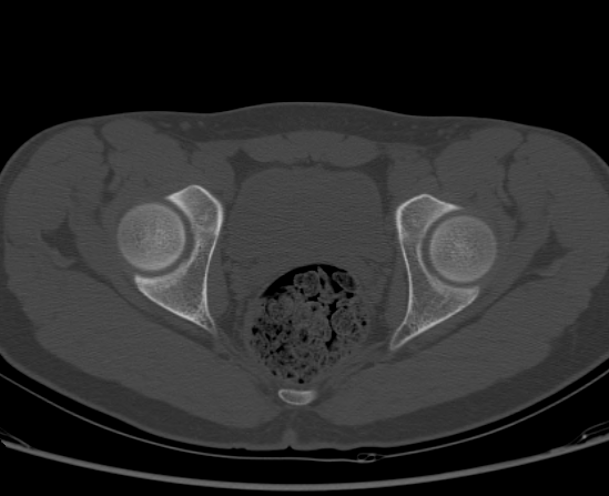 File:Aneurysmal bone cyst of ischium (Radiopaedia 25957-26094 Axial bone window 54).png