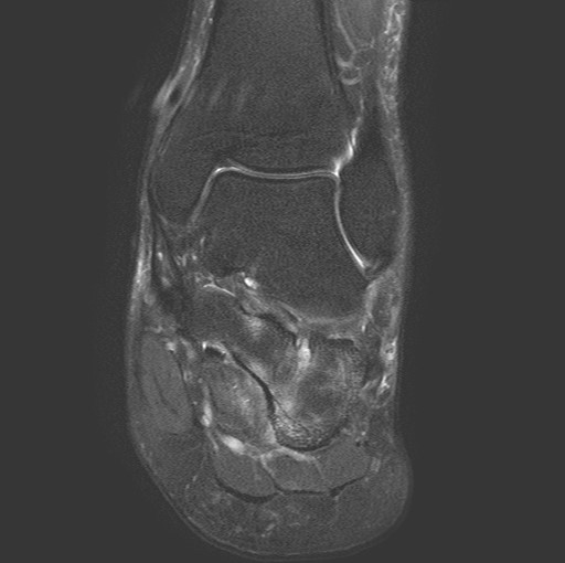 File:Aneurysmal bone cyst of the calcaneus (Radiopaedia 60669-68420 Coronal T2 fat sat 9).jpg