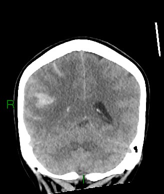 File:Aneurysmal subarachnoid hemorrhage with intra-axial extension (Radiopaedia 84371-99699 Coronal non-contrast 25).jpg