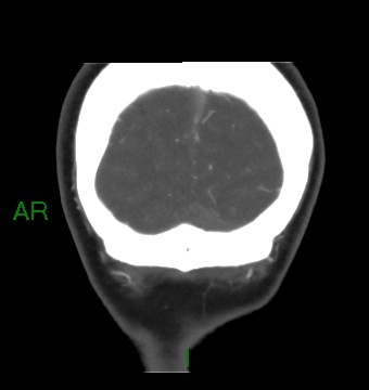 Aneurysmal subarachnoid hemorrhage with intra-axial extension (Radiopaedia 84371-99732 C 13).jpg