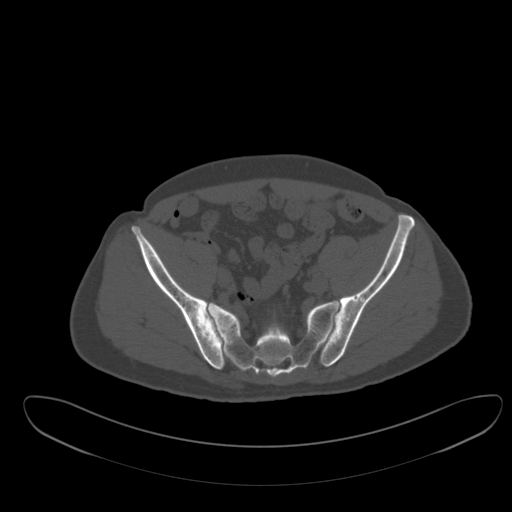Ankylosing spondylitis (Radiopaedia 52728-58645 Axial bone window 36).jpg