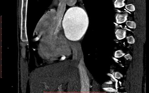 Anomalous left coronary artery from the pulmonary artery (ALCAPA) (Radiopaedia 70148-80181 C 63).jpg