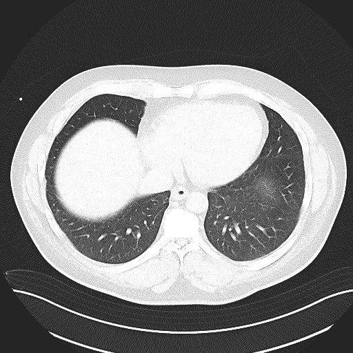 File:Anomalous origin of the left coronary artery with malignant course (Radiopaedia 77842-90126 Axial lung window 25).jpeg