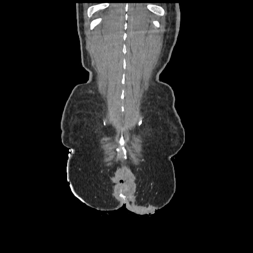 Anorectal carcinoma (Radiopaedia 44413-48064 B 87).jpg