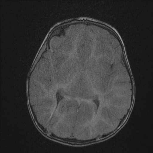 Anoxic brain injury (Radiopaedia 79165-92139 Axial MRA 122).jpg
