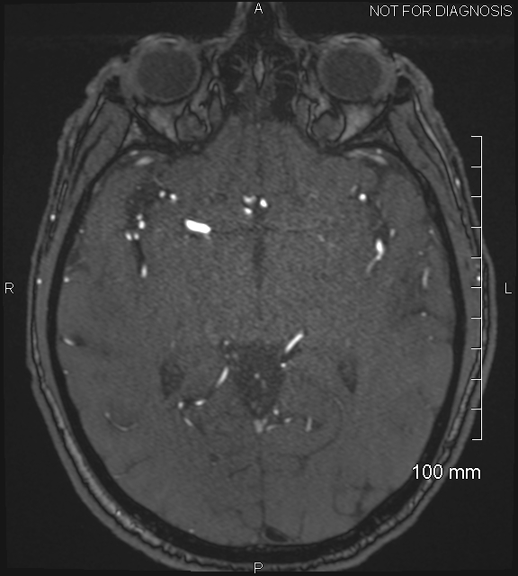 Anterior cerebral artery aneurysm (Radiopaedia 80683-94127 Axial MRA 111).jpg