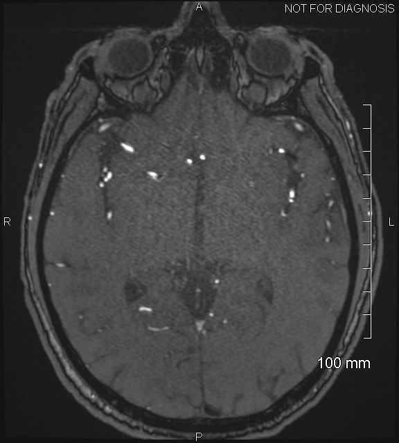 Anterior cerebral artery aneurysm (Radiopaedia 80683-94127 Axial MRA 114).jpg