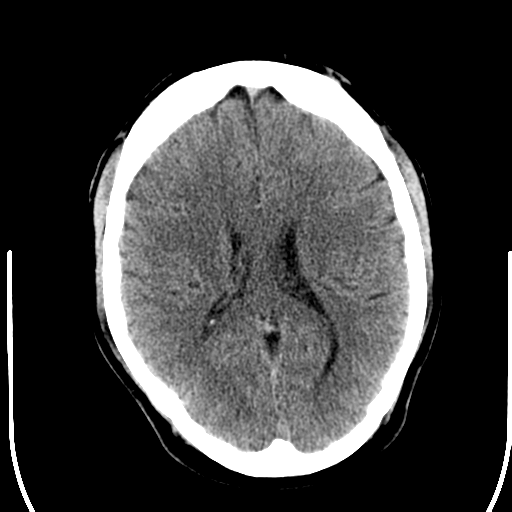 File:Anterior cerebral artery territory infarct (Radiopaedia 39327-41581 Axial non-contrast 17).png