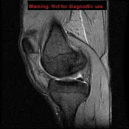 File:Anterior cruciate ligament injury - partial thickness tear (Radiopaedia 12176-12515 A 7).jpg
