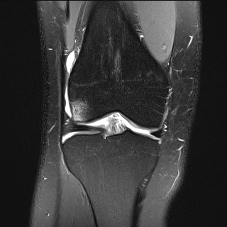 File:Anterior cruciate ligament rupture and posteromedial corner injury (Radiopaedia 67338-76723 Coronal PD fat sat 16).jpg