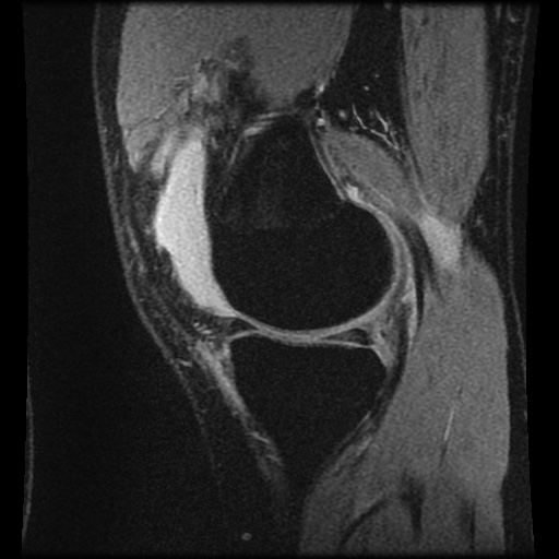 Anterior cruciate ligament tear (Radiopaedia 61500-69462 F 22).jpg