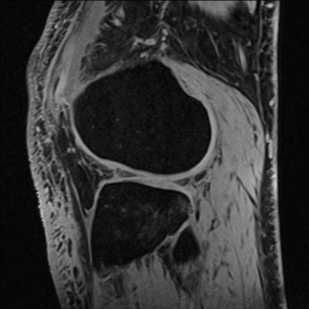 Anterior cruciate ligament tear - ramp lesion (Radiopaedia 71883-82322 Sagittal T1 vibe 41).jpg
