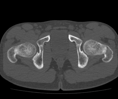Anterior inferior iliac spine avulsion fracture (Radiopaedia 81312-94999 Axial bone window 60).jpg