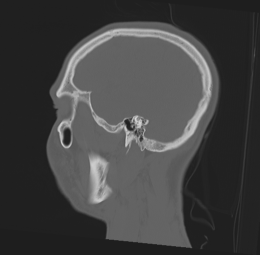 Anterior nasal spine fracture (Radiopaedia 46138-50494 Sagittal bone window 43).png