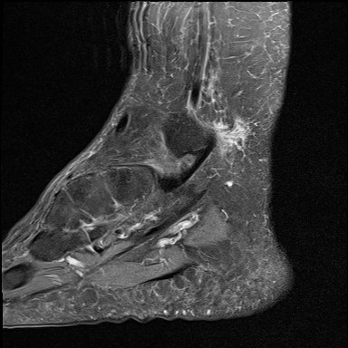 File:Anterior talofibular ligament injury - rupture with soft-tissue impingement (Radiopaedia 38765-40928 Sagittal PD fat sat 3).jpg