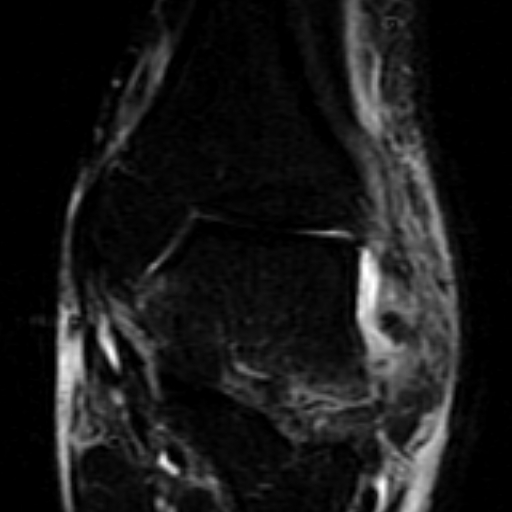 File:Anterior talofibular ligament rupture (Radiopaedia 15831-15484 Coronal STIR 9).jpg