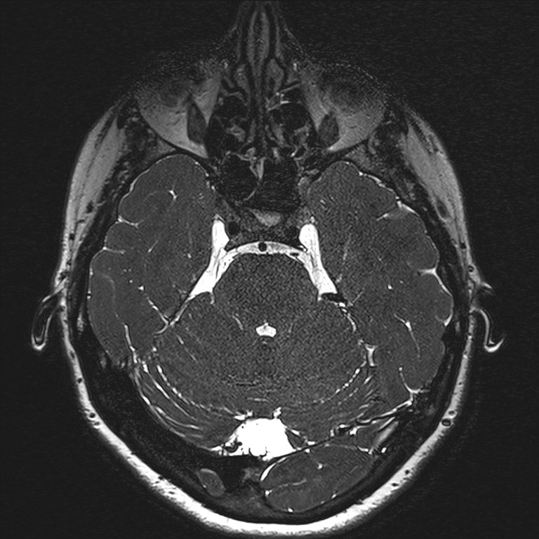 Anterior temporal encephalocele (Radiopaedia 82624-96808 Axial T2 high res 46).jpg