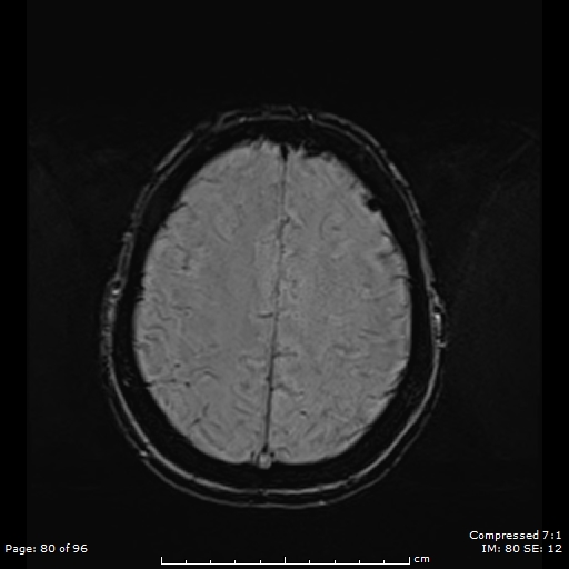 File:Anterior temporal lobe perivascular space (Radiopaedia 88283-104914 Axial SWI 49).jpg