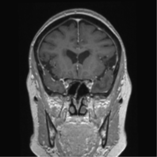 Anterior temporal pole cysts (Radiopaedia 46629-51102 Coronal T1 C+ 116).png