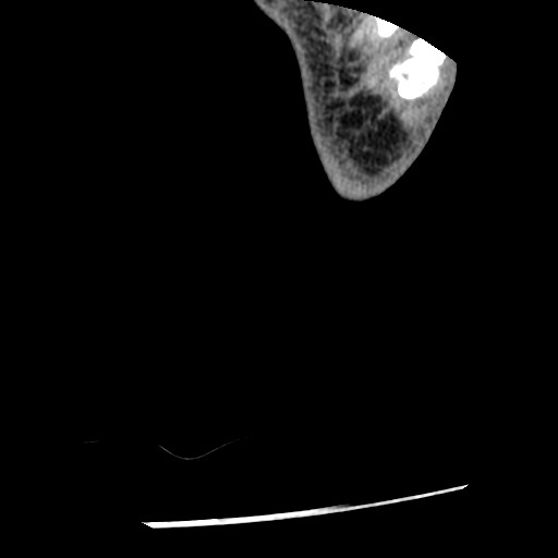 Anterior tibial artery false aneurysm (Radiopaedia 88984-105809 A 277).jpg