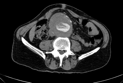 Anterior vertebral scalloping (abdominal aortic aneurysm) (Radiopaedia 66744-76067 F 56).jpg
