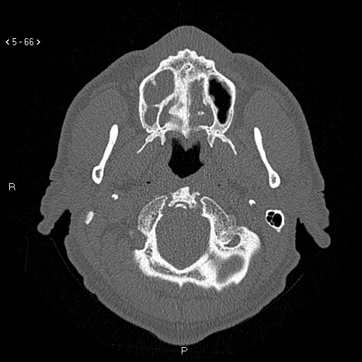 Antrochoanal Polyp (Radiopaedia 70510-80631 Axial bone window 14).jpg