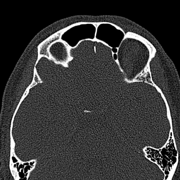 Antrochoanal polyp (Radiopaedia 30002-30554 Axial bone window 47).jpg